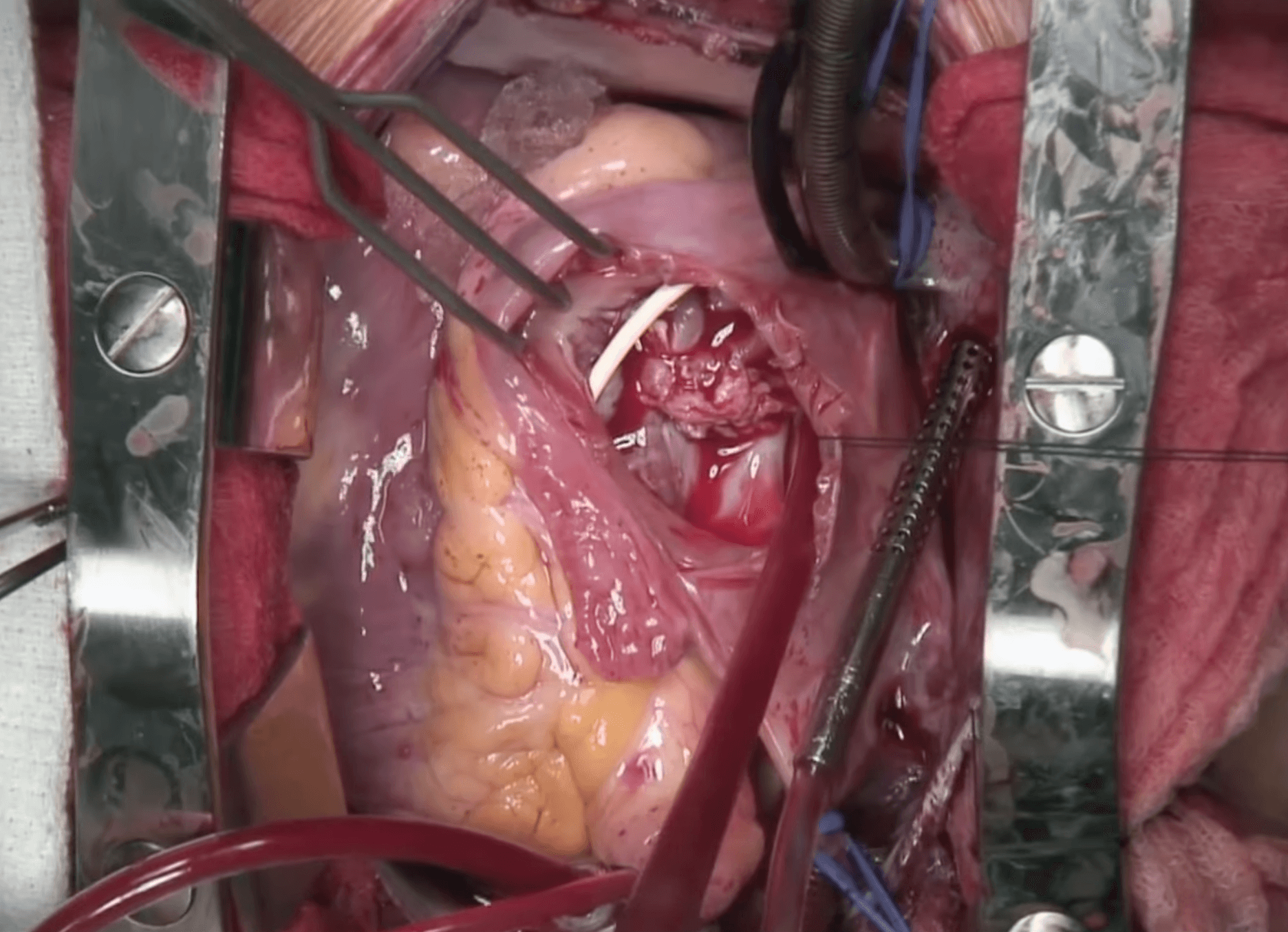 Heart surgery photorealistic