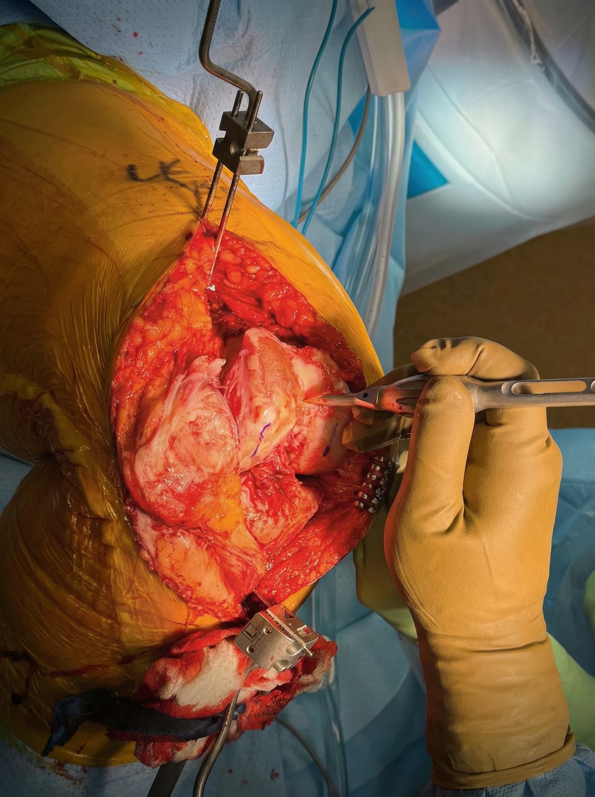 Knee surgery in Photorealistic Render style